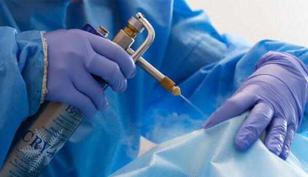 Criocirugía en lesiones cutáneas