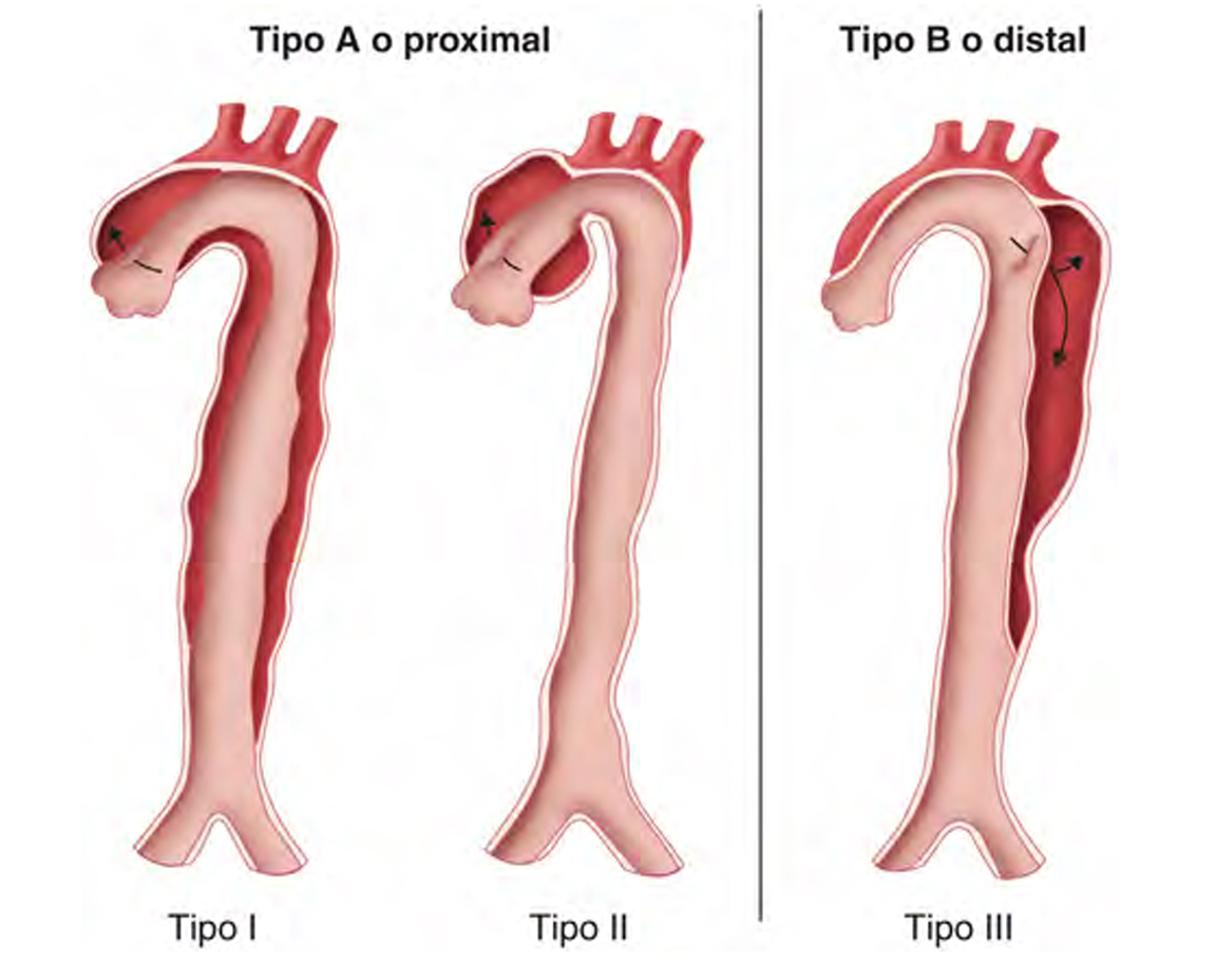 Clasificación: Hematoma intramural y disección aórticos