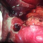 Manejo quirúrgico de la perforación gastroduodenal