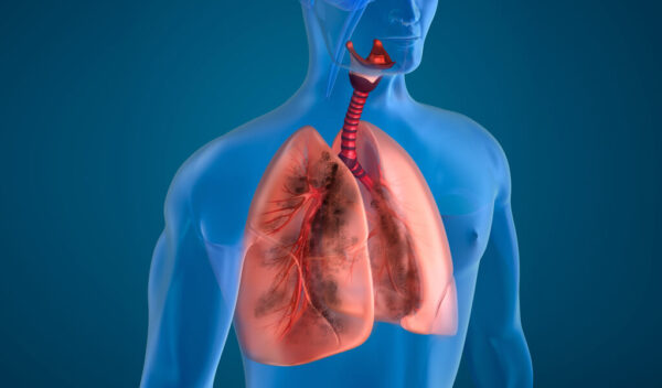 Avances en la enfermedad pulmonar obstructiva crónica