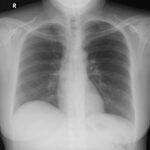 Evaluar la penetración de una placa de tórax