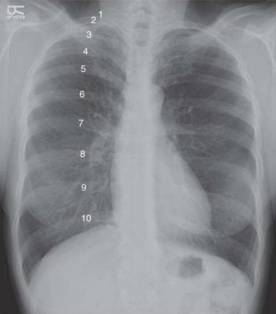 Evaluar la inspiración en una radiografía de tórax