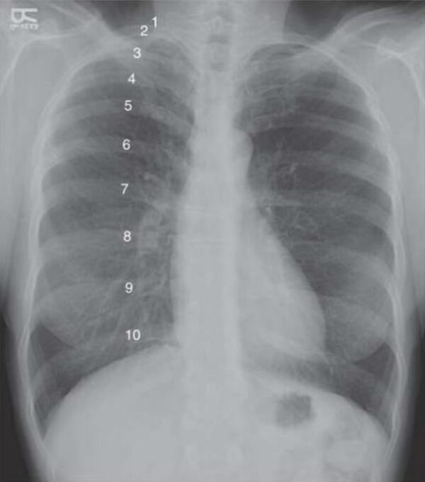 Evaluar la inspiración en una radiografía de tórax
