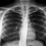 Valoración de la rotación de una radiografía de tórax