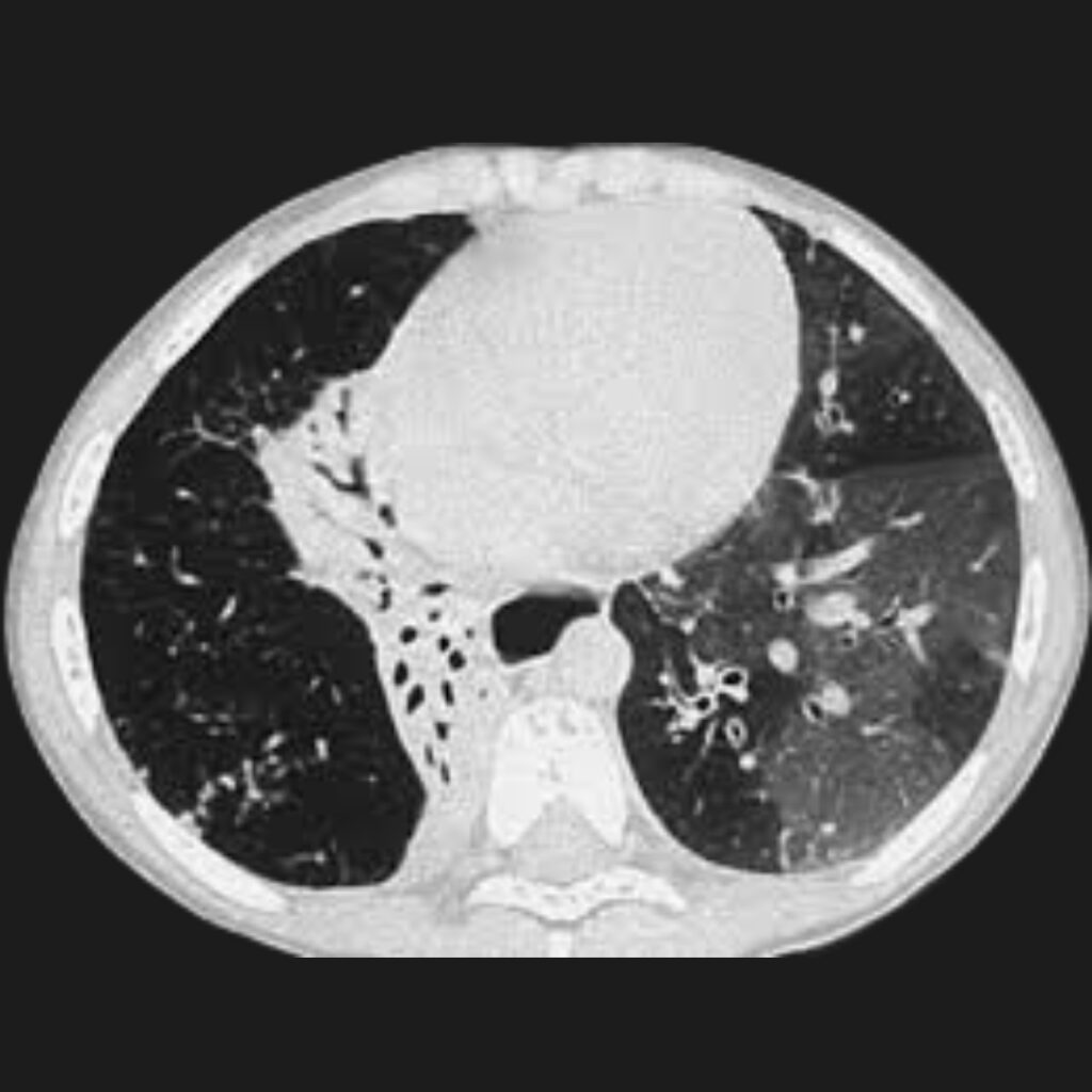 Bronquiolitis obliterante postinfecciosa en niños
