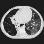 Bronquiolitis obliterante postinfecciosa en niños