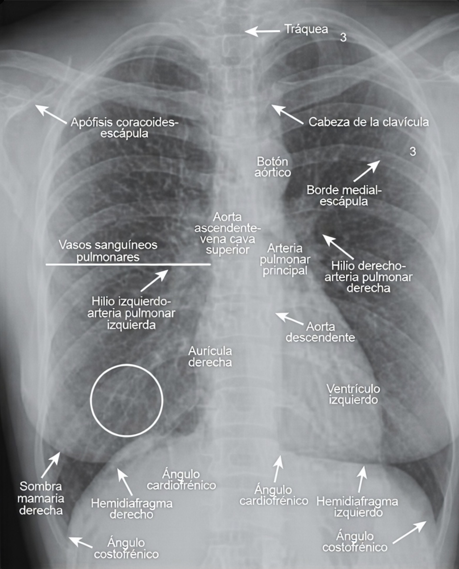 Identificación de la anatomía pulmonar normal en la radiografía frontal de tórax