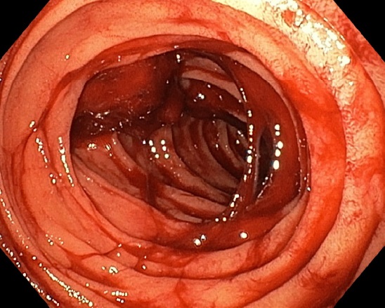 Causas e incidencia de los diverticulos duodenales