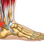 Ruptura del tendón de Aquiles