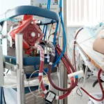 ¿Qué es el ECMO?