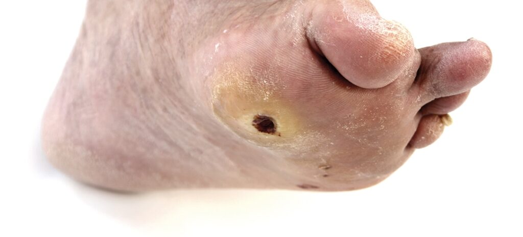 Úlceras del pie diabético