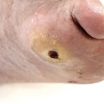 Úlceras del pie diabético