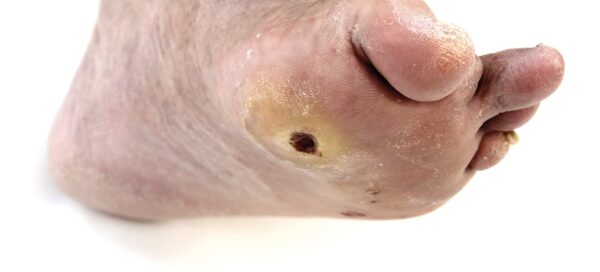 Úlceras del pie diabético