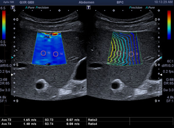 Métodos de la elastografía
