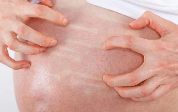 Prurito en el embarazo