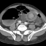 Obstrucción intestinal. Signos radiológicos.