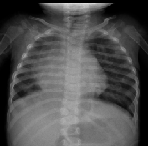 Radiografía de Tórax en Pediatría