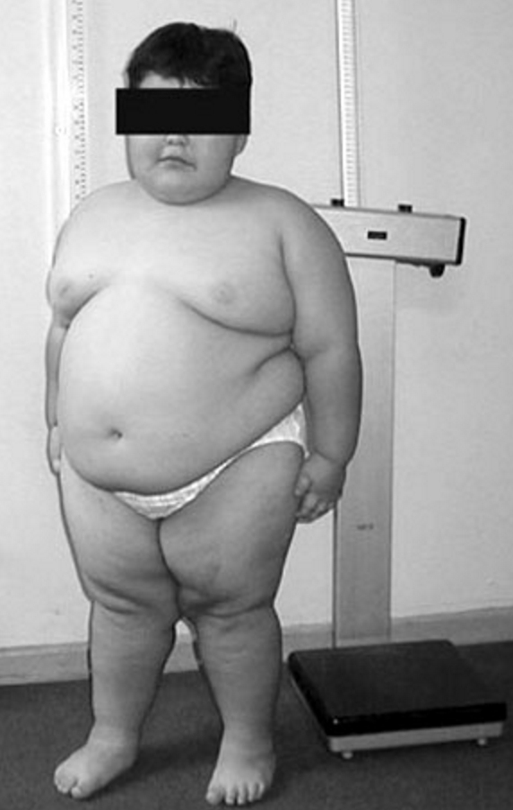 Tratamiento del Síndrome de Prader-Willi con hormona de crecimiento