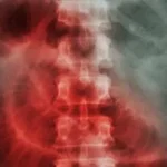 Causas de la obstrucción del intestino delgado