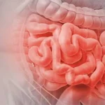 Fisiopatología de la obstrucción del intestino delgado