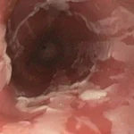Lesiones por cáusticos