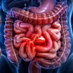 Obstrucción intestinal, la diferencia entre esperar y actuar