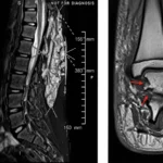Neurofibromas plexiformes en la neurofibromatosis tipo 1