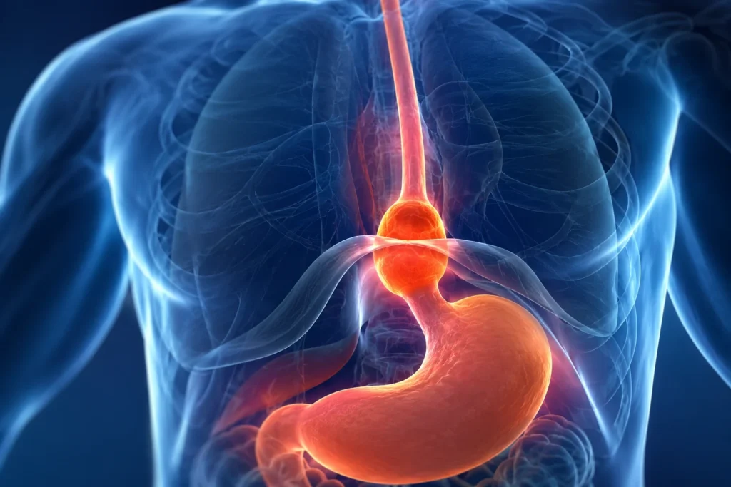 Hernia hiatal