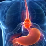 Hernia hiatal