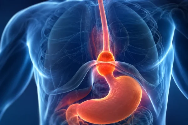 Hernia hiatal