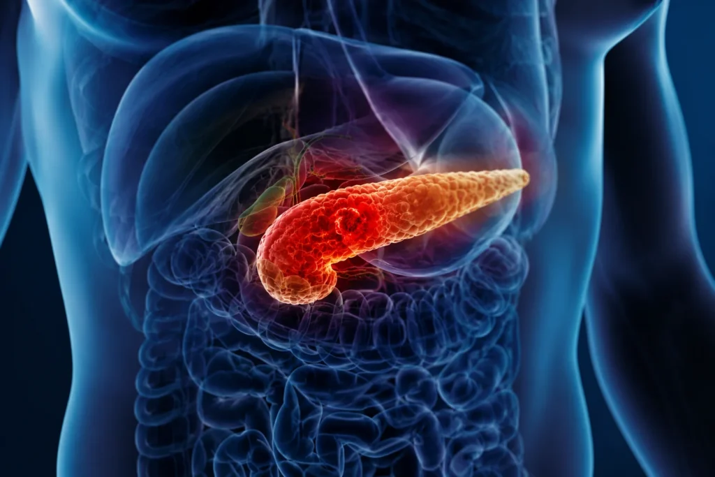Pancreatitis aguda