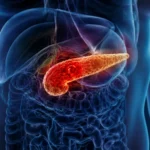 Pancreatitis aguda