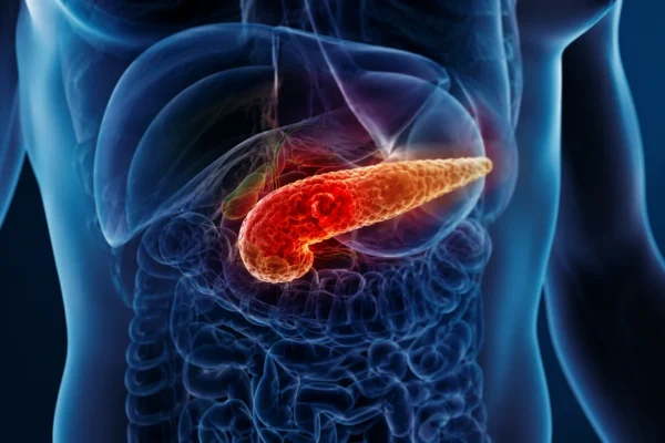 Pancreatitis aguda