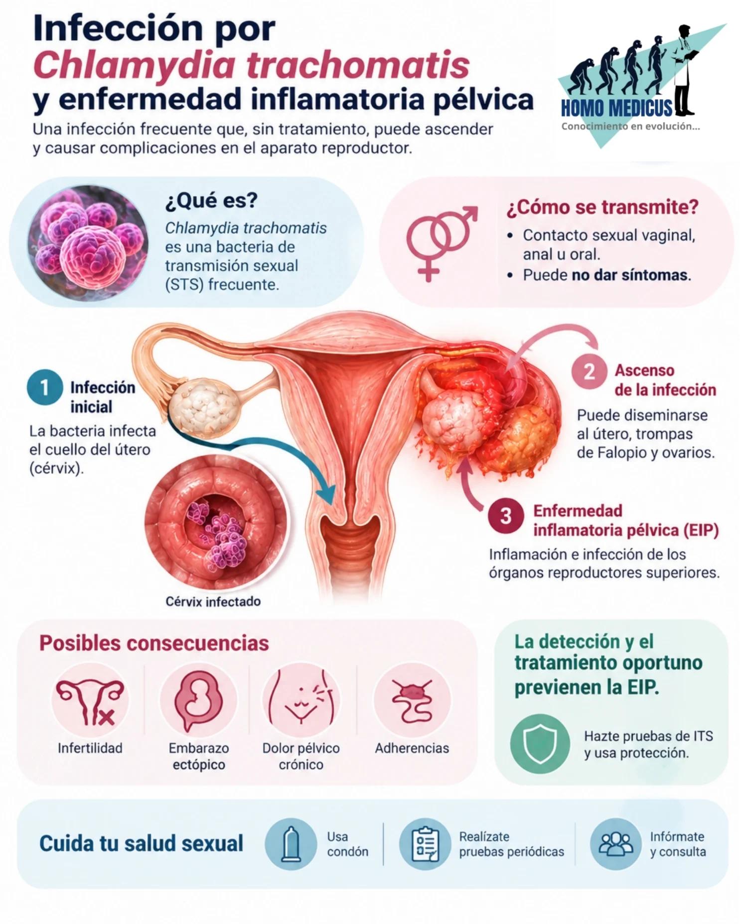 Infección por Chlamydia trachomatis y desarrollo de enfermedad inflamatoria pélvica Infección por Chlamydia trachomatis y desarrollo de enfermedad inflamatoria pélvica